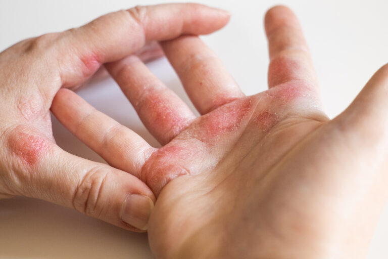 Eczema