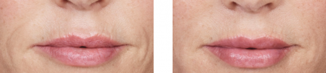 Lower Face - Before and After