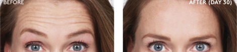 Upper Face - Before and After (1)