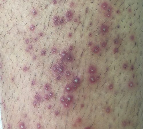 Close-up of fungal folliculitis causing clusters of small red bumps and pustules around hair follicles