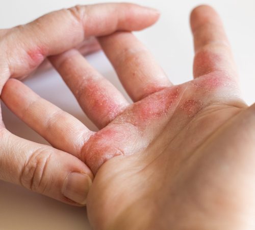 Eczema