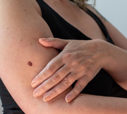 a,large,and,unusual,mole,or,freckle,on,a,woman's