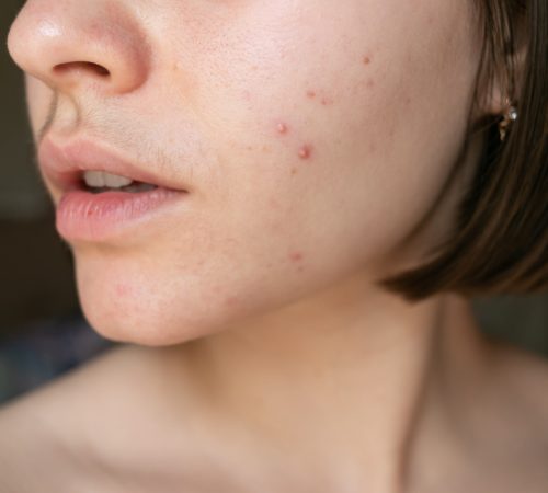 Inflammatory acne breakout on lower cheek and jawline area with visible facial hair growth indicating hormonal skin triggers.