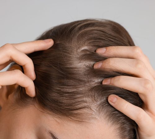 girl,with,hair,loss,problem,on,grey,background,,closeup