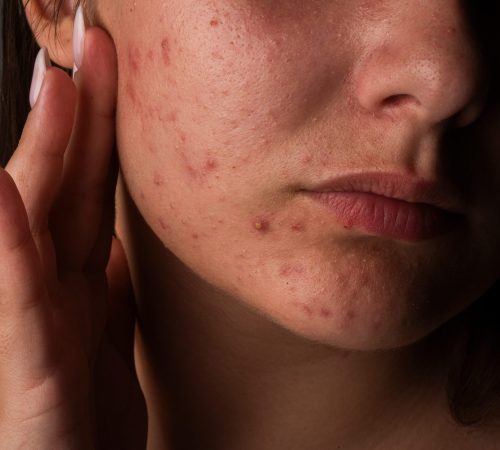 Person with acne examining vitamins and dietary supplements