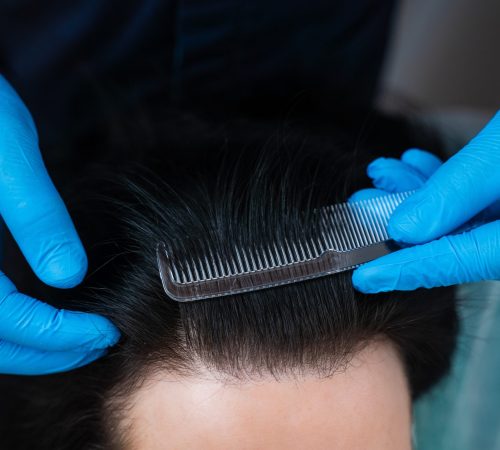Traction alopecia causing thinning along the frontal hairline
